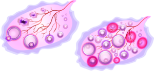 اسباب تكيس المبايض